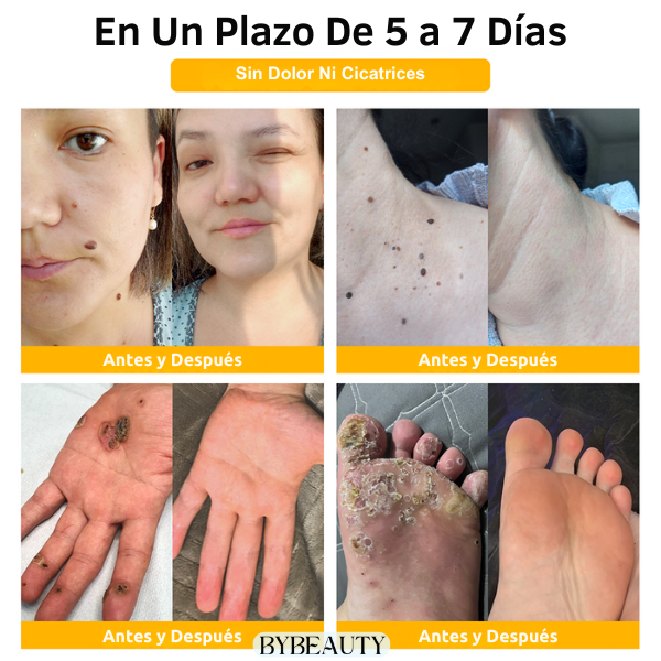 1+1 GRATIS - BEEGONE™ | ELIMINA LAS VERRUGAS Y MARCAS DE ACNE EN 7 DIAS DE FORMA 100% NATURAL