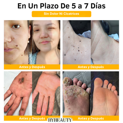 1+1 GRATIS - BEEGONE™ | ELIMINA LAS VERRUGAS Y MARCAS DE ACNE EN 7 DIAS DE FORMA 100% NATURAL