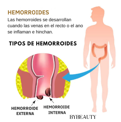 1+1 GRATIS - HEMORRHOID NATURAL OINTMENT™ | ALIVIO INSTANTÁNEO Y NATURAL PARA HEMORROIDES