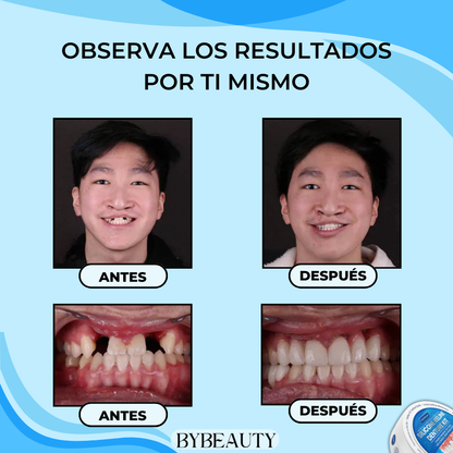 1+1 GRATIS - PERFECTDENT™ | LA SOLUCION INSTANTÁNEA PARA UNA SONRISA PERFECTA